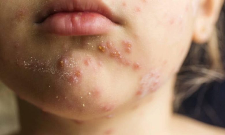 bulgaristan kizamik salgini